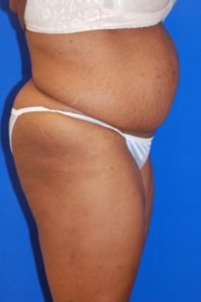 Tummy Tuck Case 3596 Tummy Tuck After Photo Tummy Tuck