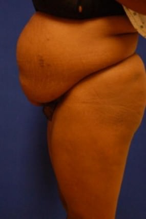 Tummy Tuck Case 3596 Tummy Tuck Before Photo Tummy Tuck