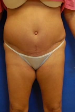 Tummy Tuck Case 3603 Tummy Tuck After Photo Tummy Tuck