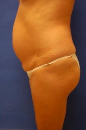 Tummy Tuck Case 3603 Tummy Tuck Before Photo Tummy Tuck