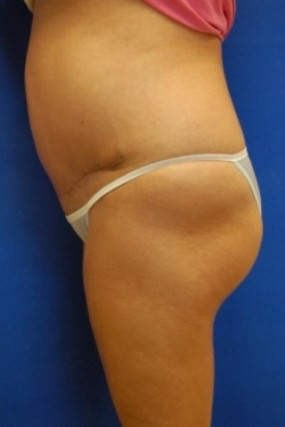 Tummy Tuck Case 3603 Tummy Tuck After Photo Tummy Tuck