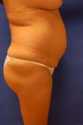 Tummy Tuck Case 3603 Tummy Tuck Before Photo Tummy Tuck