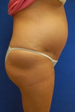 Tummy Tuck Case 3603 Tummy Tuck After Photo Tummy Tuck