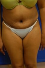 Tummy Tuck