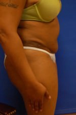 Tummy Tuck