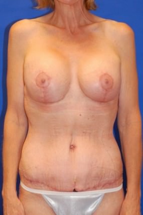Tummy Tuck Case 3617 Tummy Tuck After Photo Tummy Tuck