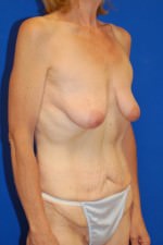 Tummy Tuck