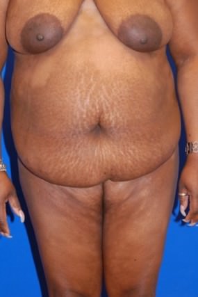 Tummy Tuck