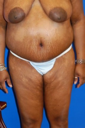 Tummy Tuck