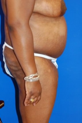 Tummy Tuck