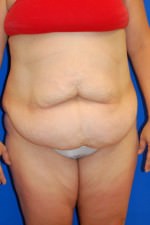 Tummy Tuck