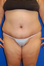 Tummy Tuck