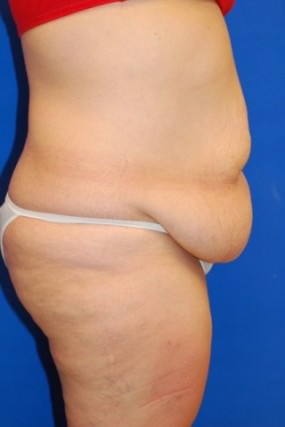 Tummy Tuck