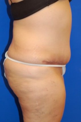 Tummy Tuck