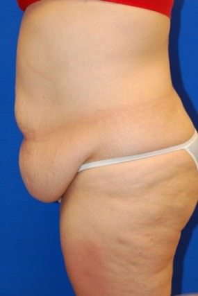 Tummy Tuck