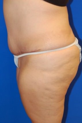 Tummy Tuck