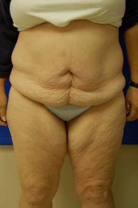 Tummy Tuck Case 3652 Tummy Tuck Before Photo Tummy Tuck