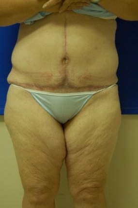 Tummy Tuck Case 3652 Tummy Tuck After Photo Tummy Tuck