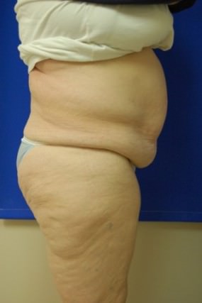 Tummy Tuck Case 3652 Tummy Tuck Before Photo Tummy Tuck