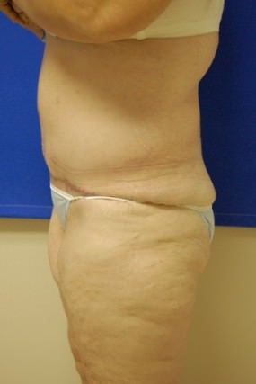 Tummy Tuck Case 3652 Tummy Tuck After Photo Tummy Tuck