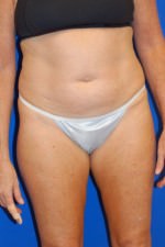 Tummy Tuck