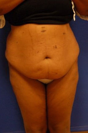 Tummy Tuck