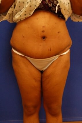 Tummy Tuck