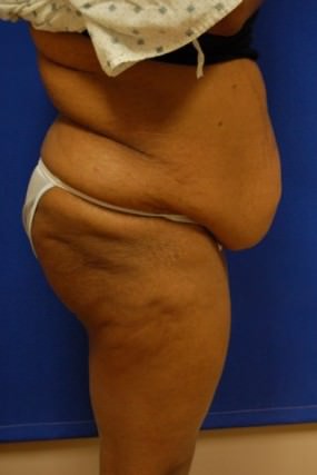 Tummy Tuck