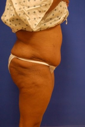 Tummy Tuck