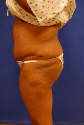 Tummy Tuck