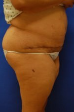 Tummy Tuck