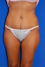 Tummy Tuck