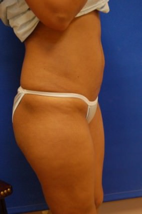 Tummy Tuck