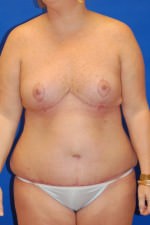 Tummy Tuck