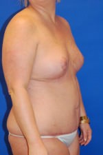 Tummy Tuck