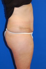 Tummy Tuck