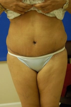 Tummy Tuck Case 3708 Tummy Tuck After Photo Tummy Tuck