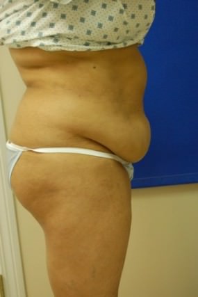 Tummy Tuck Case 3708 Tummy Tuck Before Photo Tummy Tuck