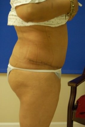 Tummy Tuck Case 3708 Tummy Tuck After Photo Tummy Tuck
