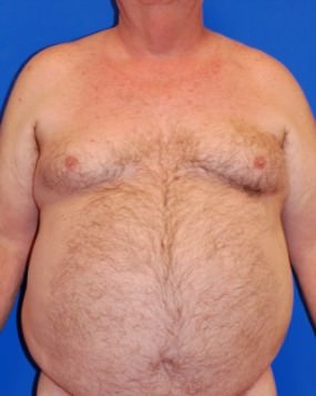 Male Breast Reduction