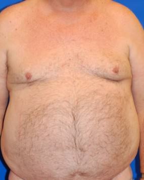 Male Breast Reduction