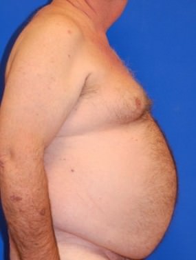 Male Breast Reduction