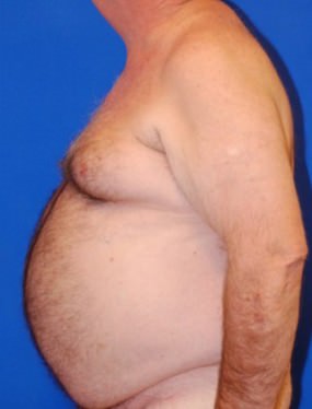 Male Breast Reduction