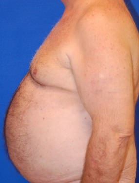 Male Breast Reduction