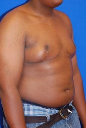 Male Breast Reduction