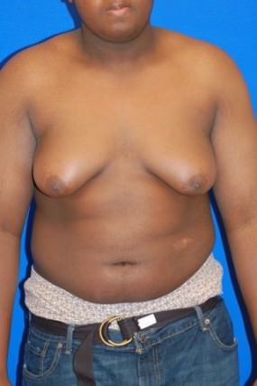 Male Breast Reduction