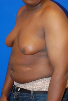 Male Breast Reduction