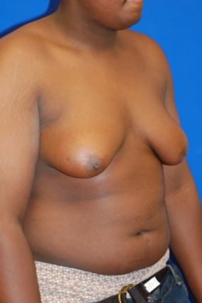 Male Breast Reduction