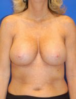 Breast Augmentation