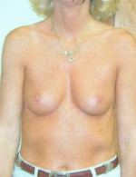 Breast Augmentation